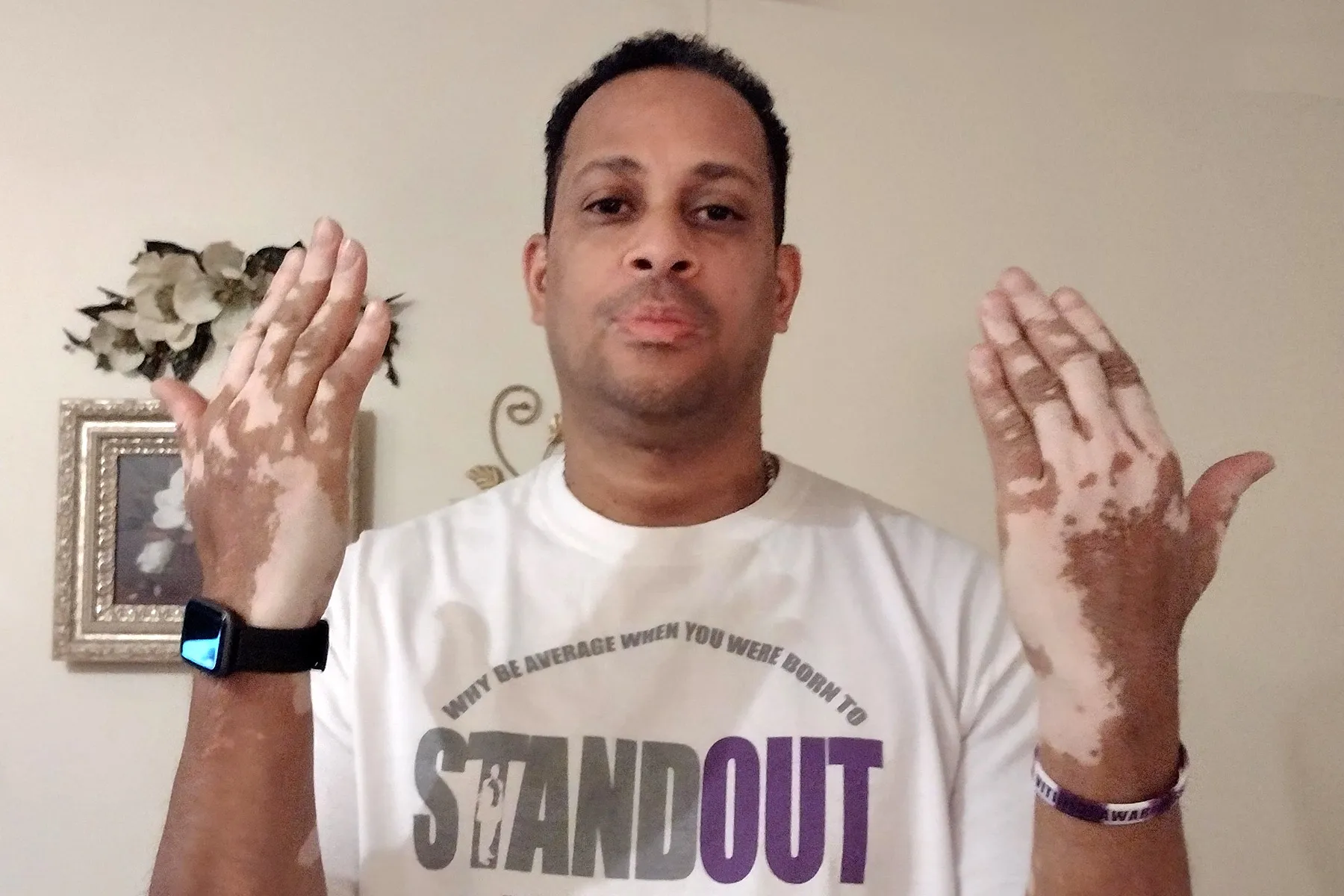 Vitiligo: My Life With This Skin Condition