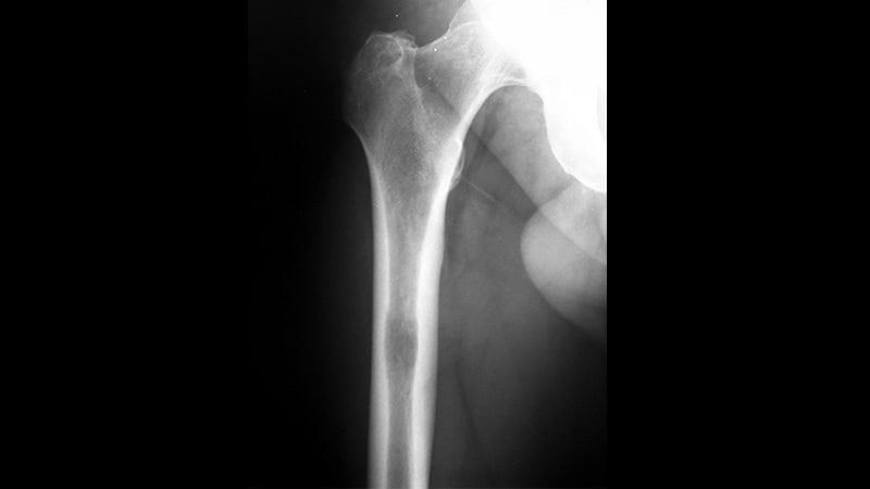 SBRT Safe, Effective for Patients With Nonspine Bone Mets