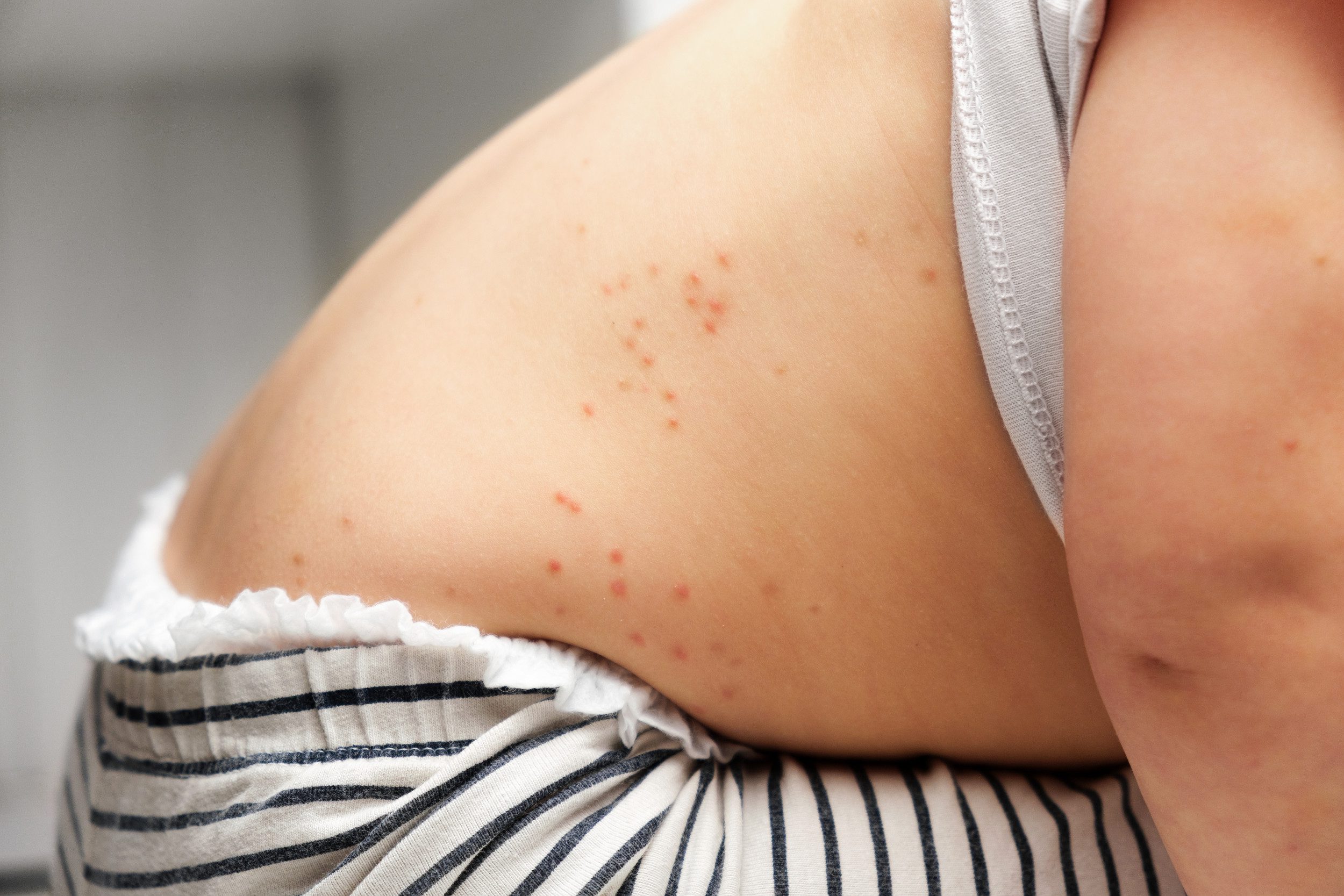 Measles Outbreak Map Shows Nine States Where Disease Reported