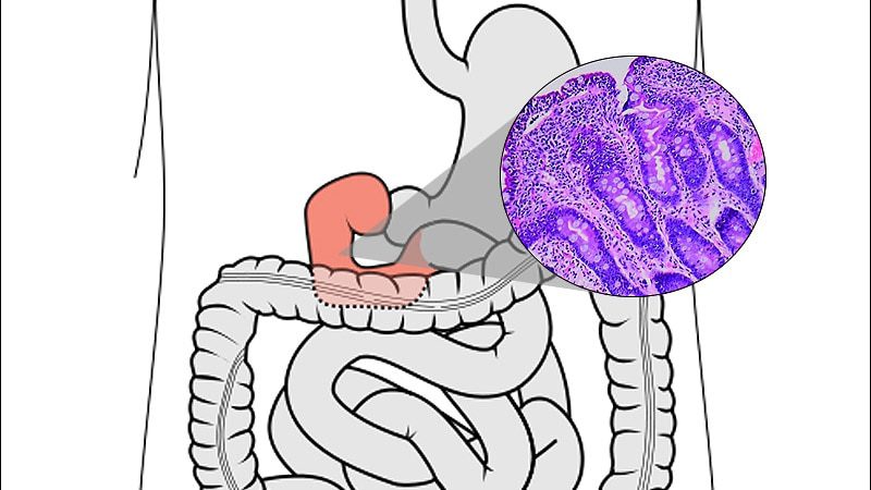 Can Iron Supplementation Protect Against Celiac Disease?