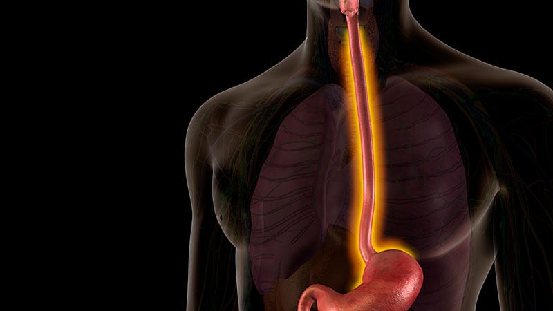 Eosinophilic Esophagitis: 5 Things to Know