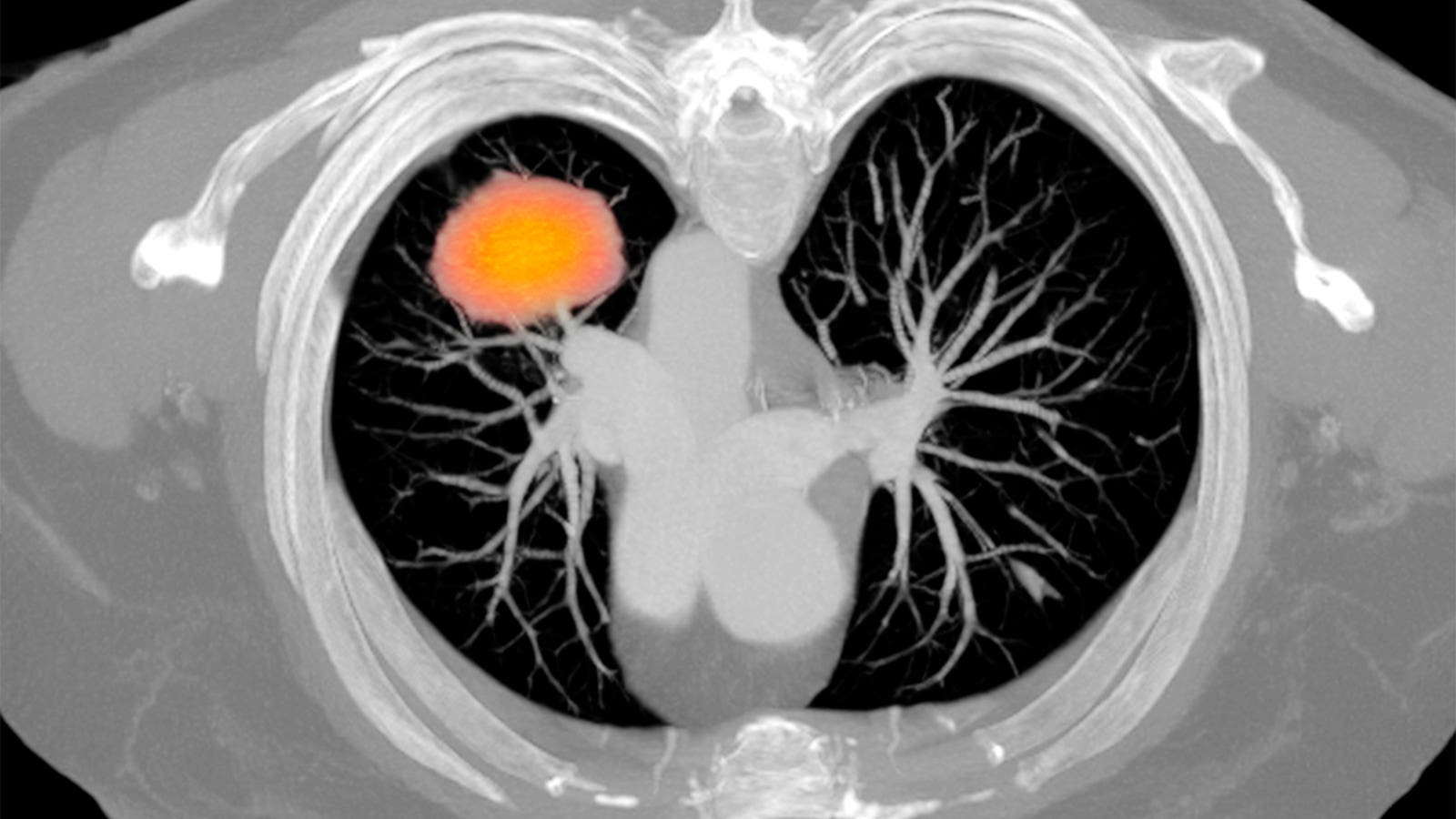 Perioperative Tislelizumab Demonstrates Survival Benefit in NSCLC