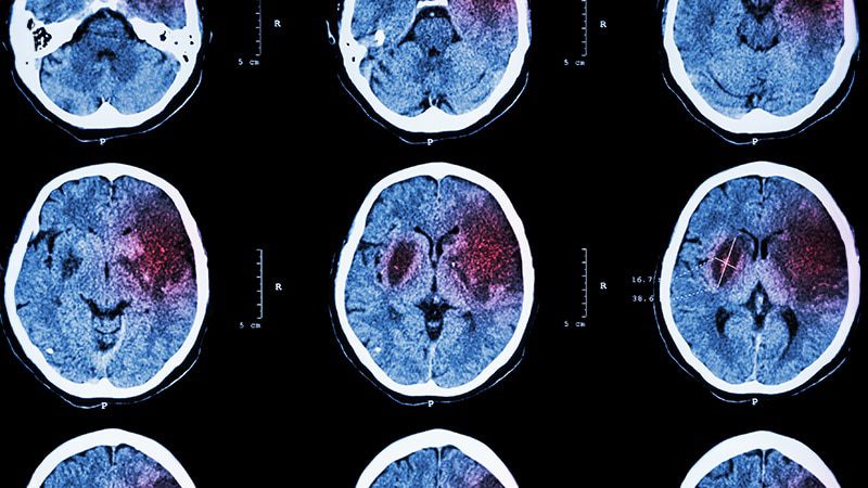 Stroke Incidence Higher Among Indigenous People