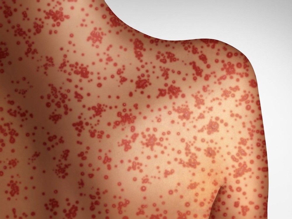 OPH urging parents to get children’s measles vaccinations up to date