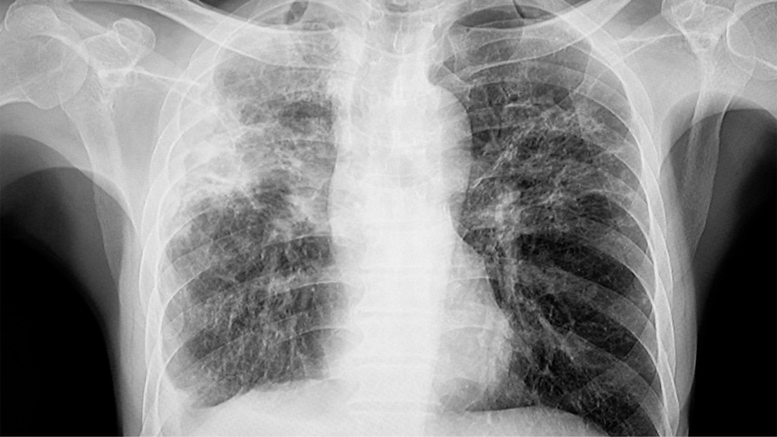 New Tuberculosis Framework May Improve Research, Clinical Care