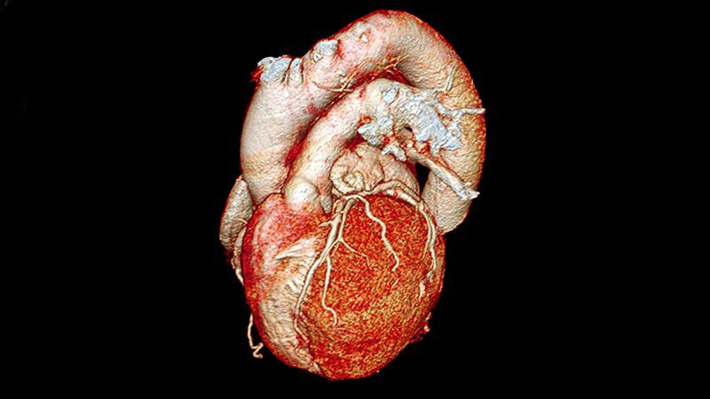 Complete Revasc Not Superior to Culprit-Only PCI After MI