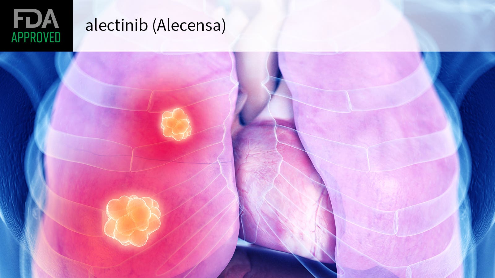 Alectinib Lands FDA Approval for Adjuvant Therapy in NSCLC