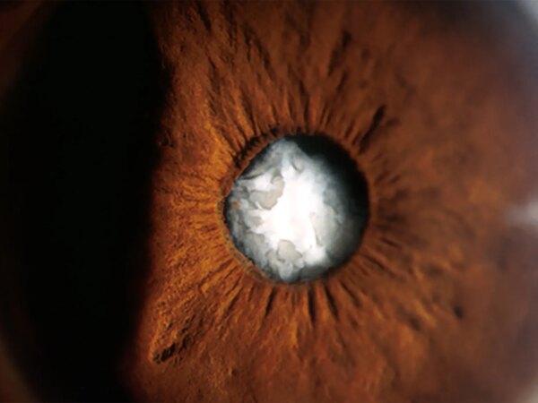 Cataract Surgery Tricky for Those With Past Radial Keratotomy