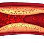 Catheter-directed mechanical thrombectomy system demonstrates safety and effectiveness in pulmonary embolism patients