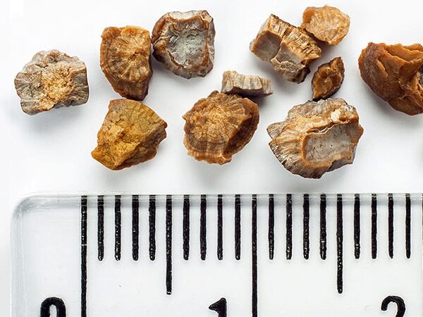 Office Procedure Found to Get Stone Fragments Rolling