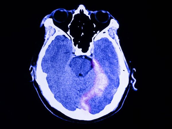 Prophylaxis Cuts Posttraumatic Seizure Risk in TBI