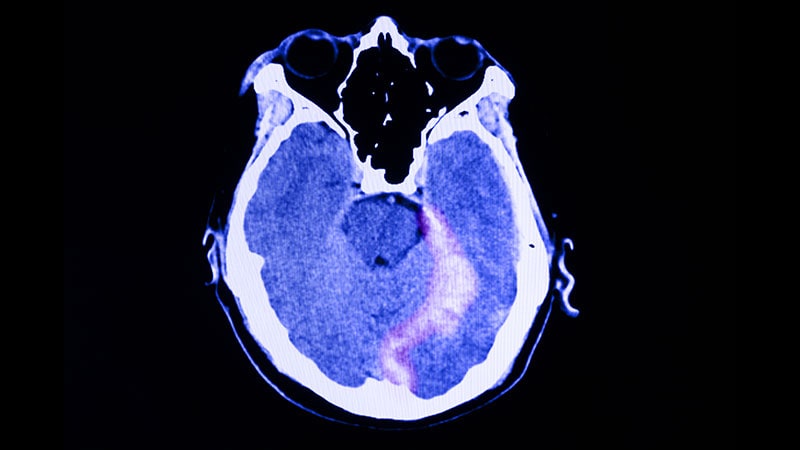 Prophylaxis Cuts Posttraumatic Seizure Risk in TBI